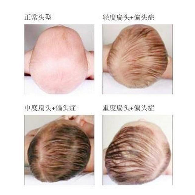 婴儿头后仰原因是什么 石河子市安红昭：关于宝宝的专家推荐
