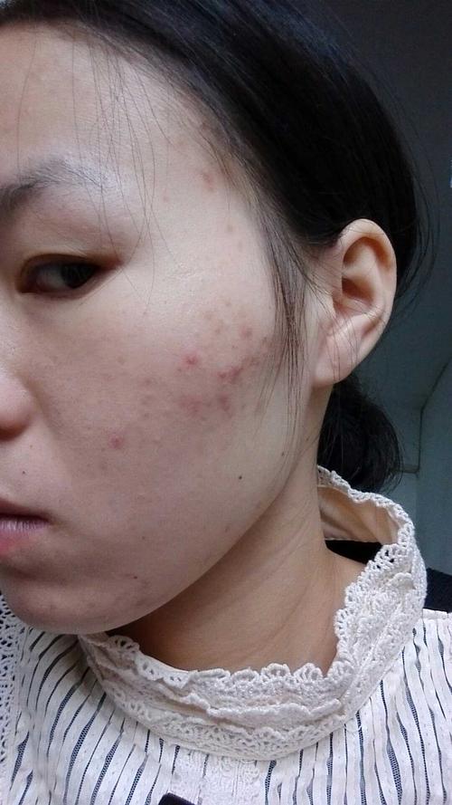 怀孕了脸上老是长痘痘怎么回事 梧州市狄真荣:关于怀孕后的专家推荐