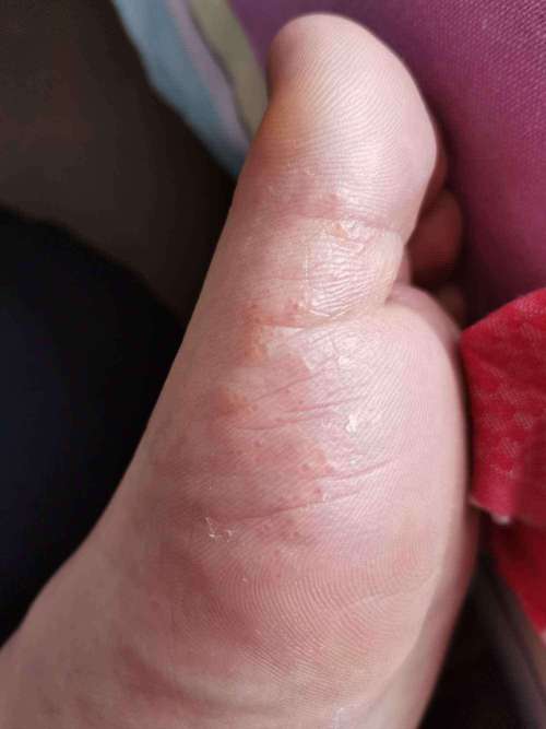 小孩脚痒怎么办最快最有效 邴悦苑关于小儿的常识介绍