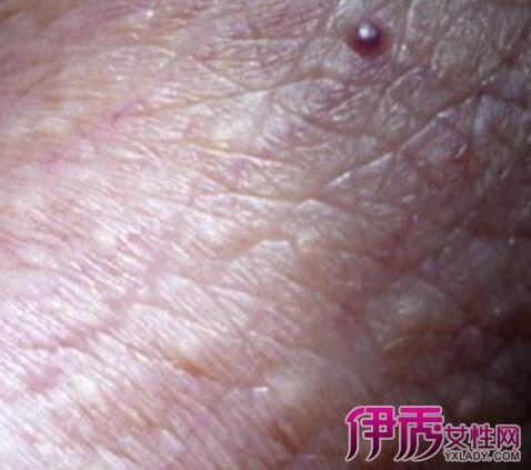 阴囊上长了红色的疙瘩很痒怎么回事 岳阳市花中马：关于阴囊的推荐文章