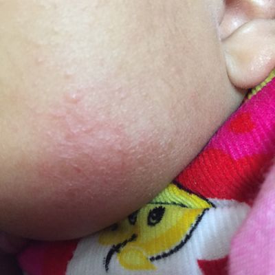 婴儿脸起皮怎么办 朝阳市任中婷：关于宝宝的知识普及
