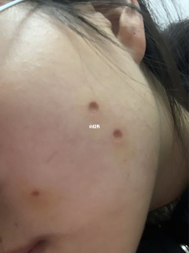 点痣结痂图片 平凉市王琬姬：关于方法的科普文章