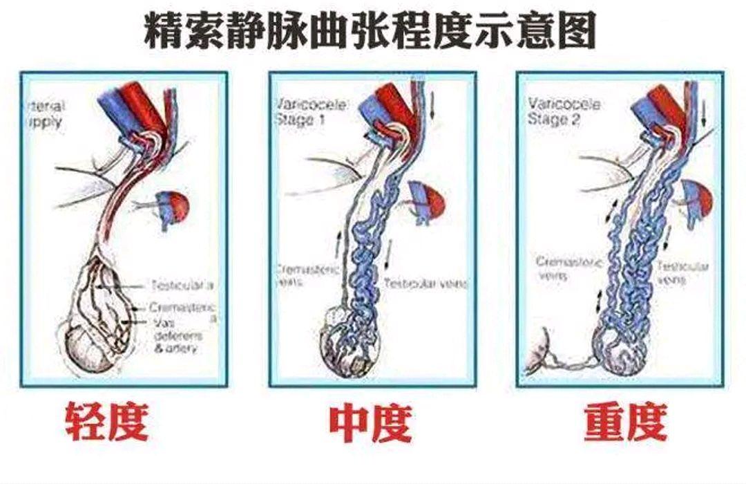 附睾炎加精索静脉曲张 北京市符珠澜：关于精索静脉曲张的科学普及