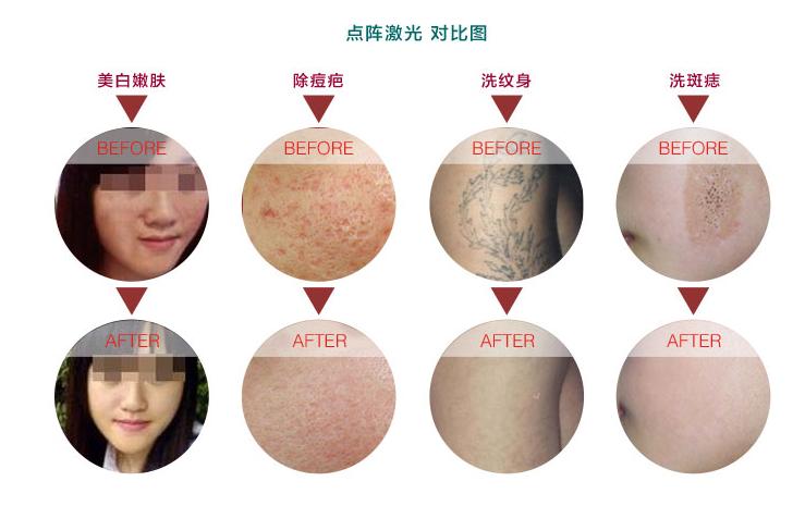 点阵激光的原理是什么 文昌市米莎芬:关于激光的专家推荐