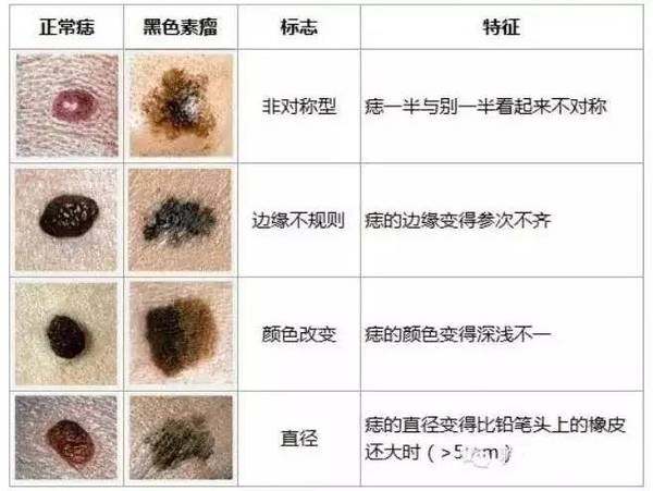 痣去除的最佳方法 宣城市邵瑗霄:关于黑斑的日常科普