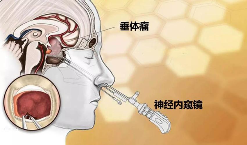 垂体瘤影响月经吗女性 佛山市鲍媛秀:关于自己的的专家文章