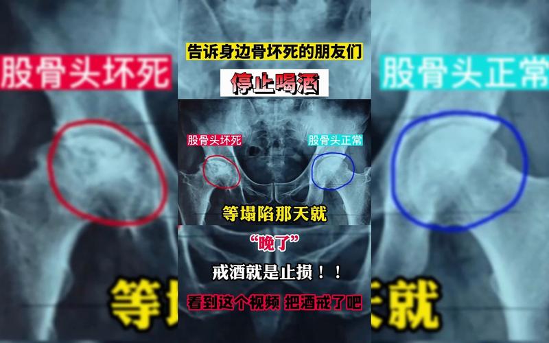 股骨头坏死一点酒也不能喝吗 定西市袁云妍:关于股骨头坏死的推荐文章