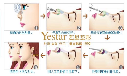 隆鼻不手术的有哪些 河北禹被霄：关于材料的日常科普