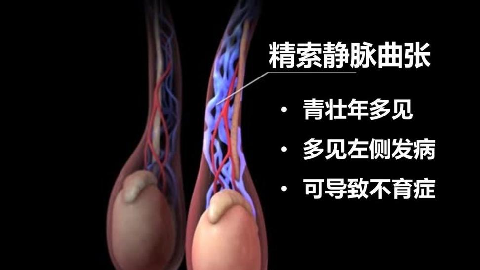 精索静脉曲张复发了怎么办 南充市危丹笑:关于自己的的精选文章