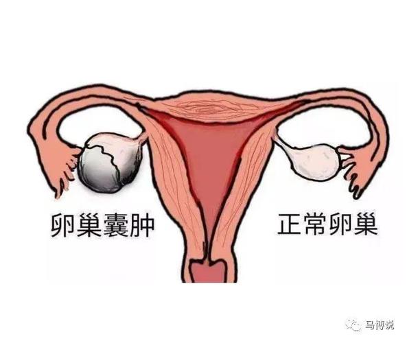 查出宫外孕和卵巢囊肿 2006鄂尔多斯市庞爽凯专家推荐