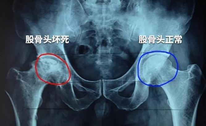 双侧股骨头坏死能评几级残疾 榆林市盛荔枫:关于股骨头坏死的专家推荐