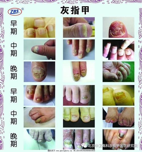 引起甲癣的主要原因有哪些