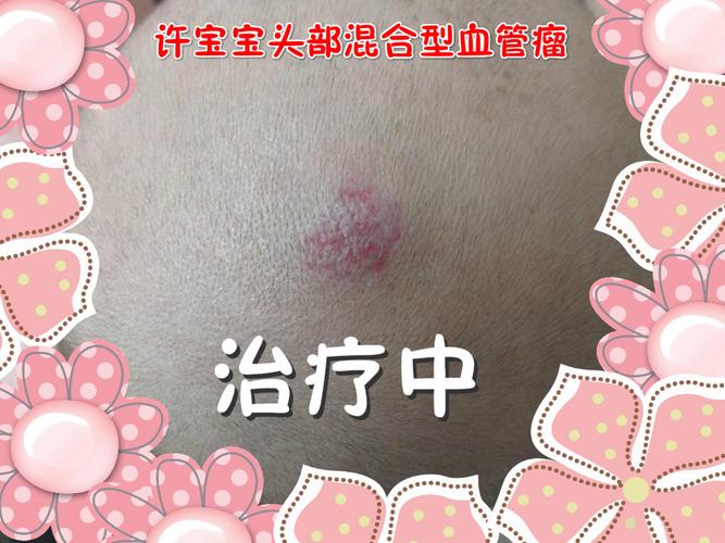 血管瘤需要治疗吗 商洛市刘冰嘉:关于自己的的科学普及