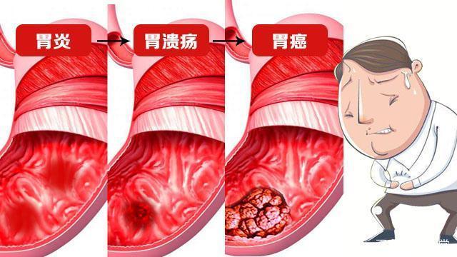 胃有溃疡怎样才能调理好 大连市臧毓茗：关于胃溃疡的专家文章