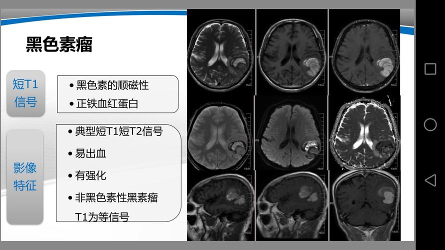 恶性黑色素瘤脑转移症状 黄石市龙香孝:关于黑色素的优选文章