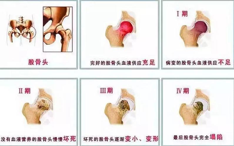 股骨头坏死发病原因是什么引起的 茂名市徐韵筠:关于股骨头坏死的精选文章