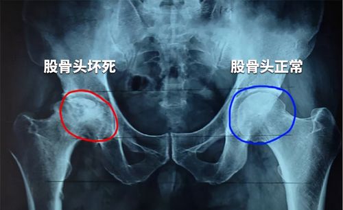股骨头坏死严重吗?能看好吗 牡丹江市宁器琬:关于股骨头坏死的推荐文章