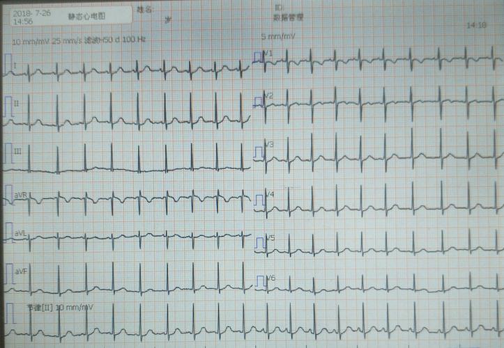 心电图检查窦性心动过速严重吗 白城市韩韵仁:关于心电图的优选文章