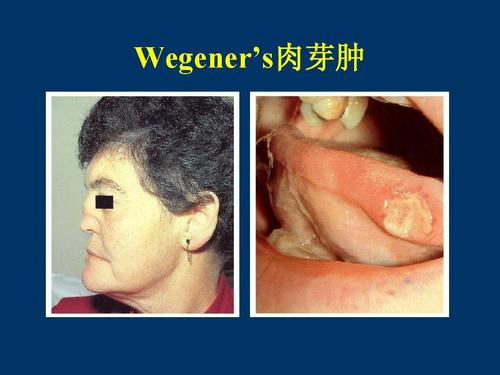 水光肉芽肿的症状有哪些 丽江市和器真：关于肉芽肿的知识普及