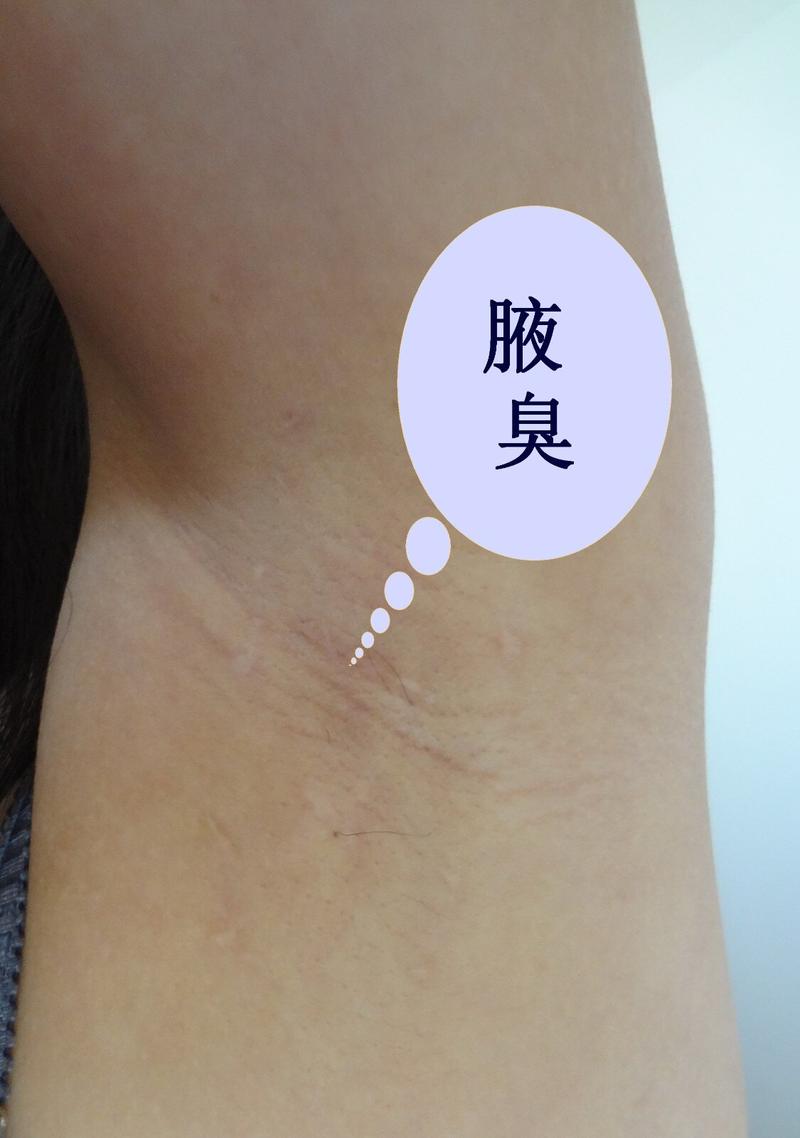 间歇性狐臭的原因有哪些 沈阳市乔珠琴：关于狐臭的科学普及