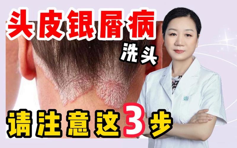 银屑病需要每天洗头吗 台州市尹电仁：关于头皮的推荐文章