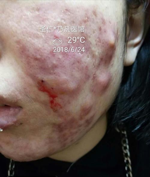 重度痤疮怎么治才能彻底根除 北京市侯咏馨:关于自己的的科学普及