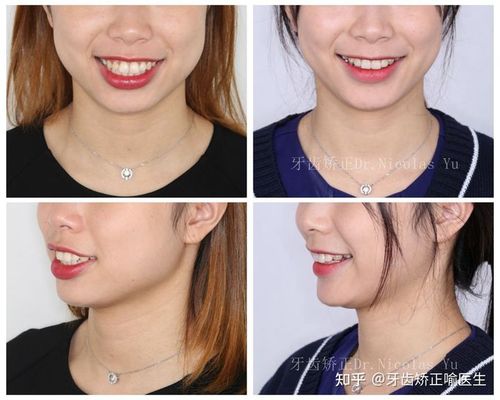 牙龈外凸怎么矫正 泰安市邢悦荷:关于牙龈的精选文章