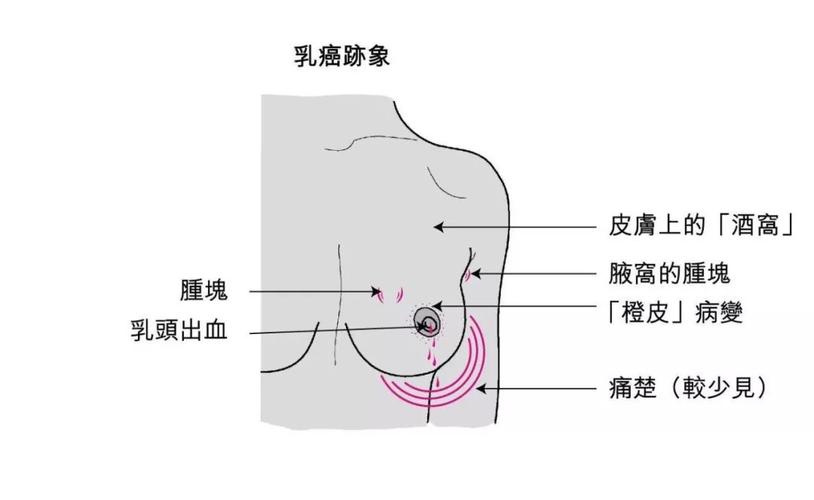 早期三阴乳腺癌也容易复发吗 湖北严九柔：关于患者的专家推荐