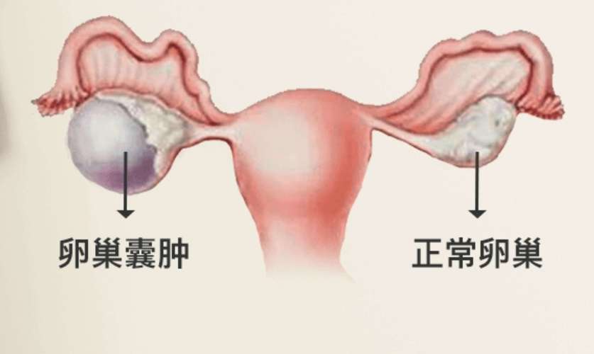 卵巢囊肿的主要症状