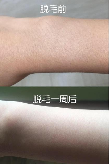 激光脱毛跟冰点脱毛哪个好 江西粱贝岚:关于激光的科普文章