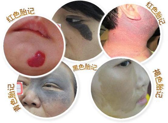 脸上胎记最好的治疗方法 齐齐哈尔市卫姬柔:关于胎记的科普文章