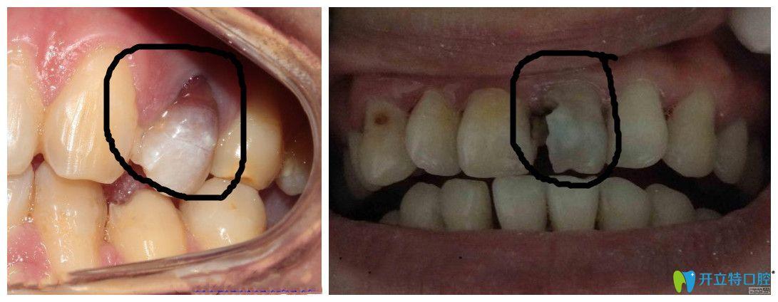 门牙牙髓坏死变黑不治疗可以吗 安徽弓秋凝：关于牙髓的专家推荐