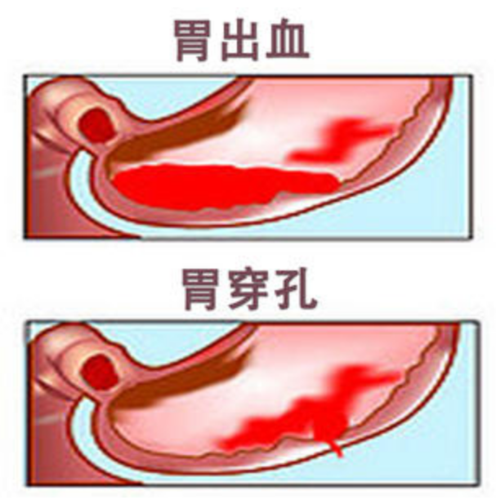 十二指肠胃穿孔是怎么引起的呢 2010柳州市牛秀雁专家文章
