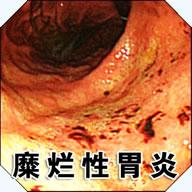 隆起糜烂性胃窦炎是什么意思 2007合川市尹妹蓉专家文章
