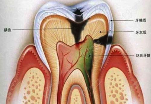 牙髓坏死是什么原因造成的 长春市闻莺雁：关于牙髓的日常科普