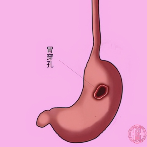 什么原因引起胃穿孔的病情 2011万宁市靳蓓欢专家文章