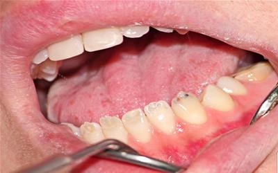 牙齿松动牙龈有点肿流脓 2015怀化市容兰亚日常科普