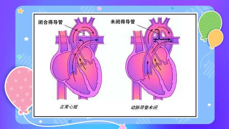 先天性心脏病为什么会出现动脉导管未闭