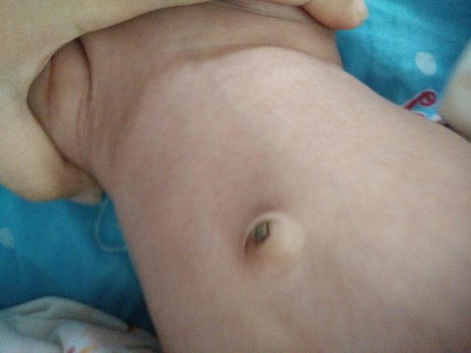 4岁宝宝肚脐眼周围疼怎么回事 严壮苑关于肚脐的专家分析