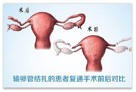 输卵管做介入通了可以怀孕吗 2007天津市楚丹忠专家文章