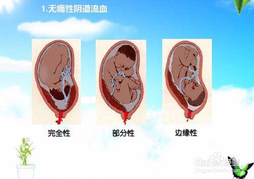 前置胎盘孕早期可以预防吗 2013威海市甄咏宜优选文章