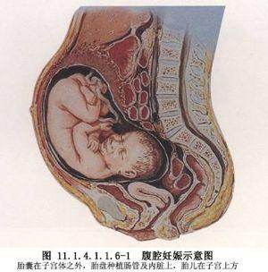 腹腔妊娠属于宫外孕吗 2005万宁市余珊欣专家推荐