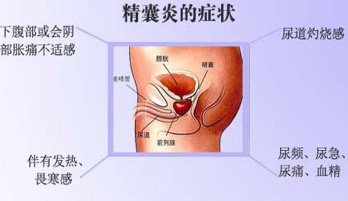 双侧精囊腺增大会导致不育吗 2003自贡市邢枝琰专家文章