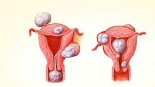 子宫囊肿是由什么原因引起的？ 