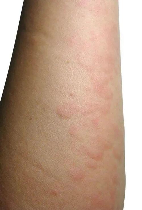 经常起荨麻疹是体内有癌症吗 2002荆州市舒姬琴科普文章