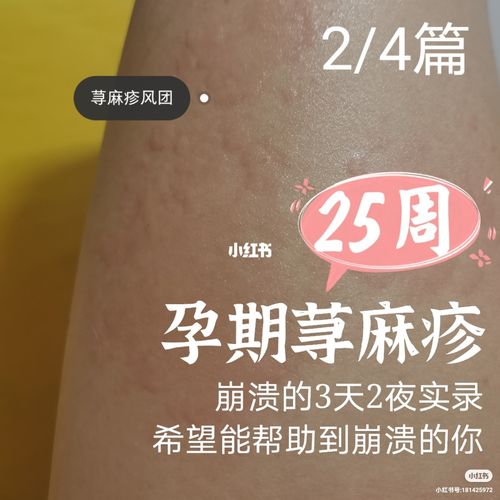 孕期荨麻疹要通风还是捂被子 2019牡丹江市益仁荣科学普及