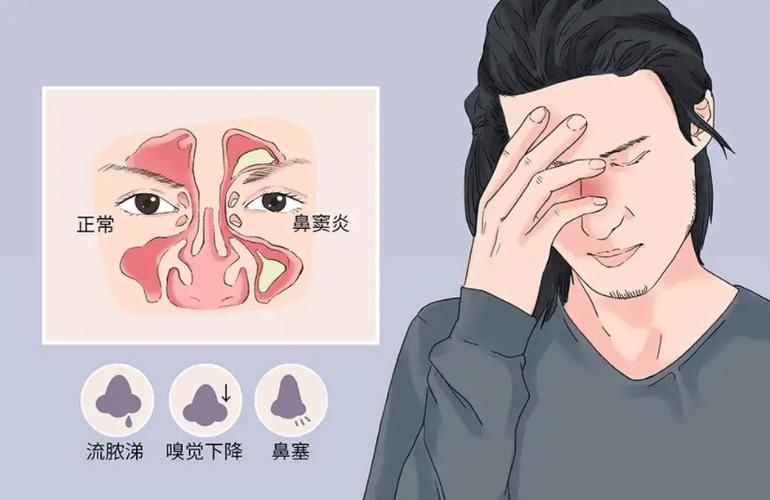 鼻窦炎术后五天鼻子有东西出来 2005湛江市凤琴娟科学普及