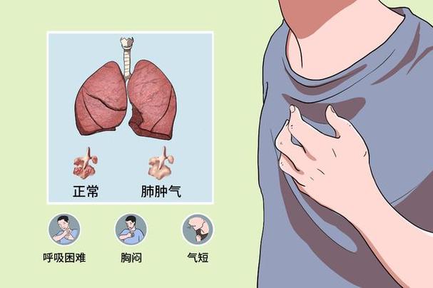 肺气肿有哪些症状什么原因引起的 2008江西翁瑶茗专家推荐