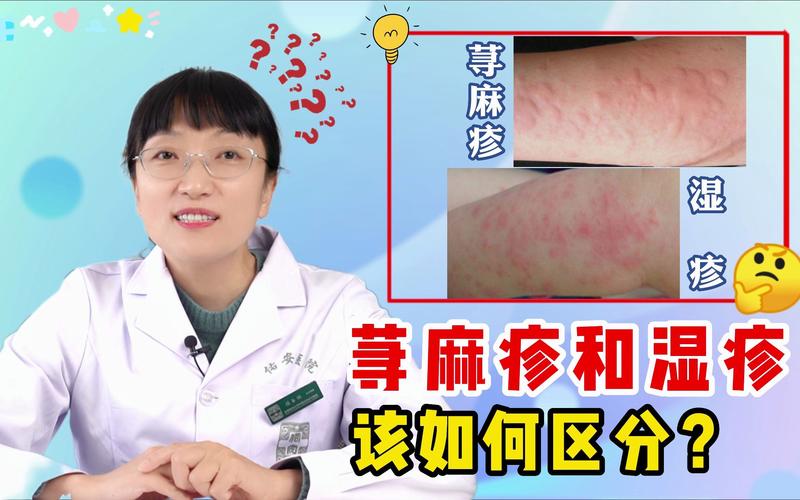 婴儿湿疹和荨麻疹的区别 2001哈尔滨市罗瑗澜日常科普