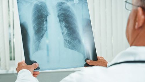 肺癌是否具有传染性